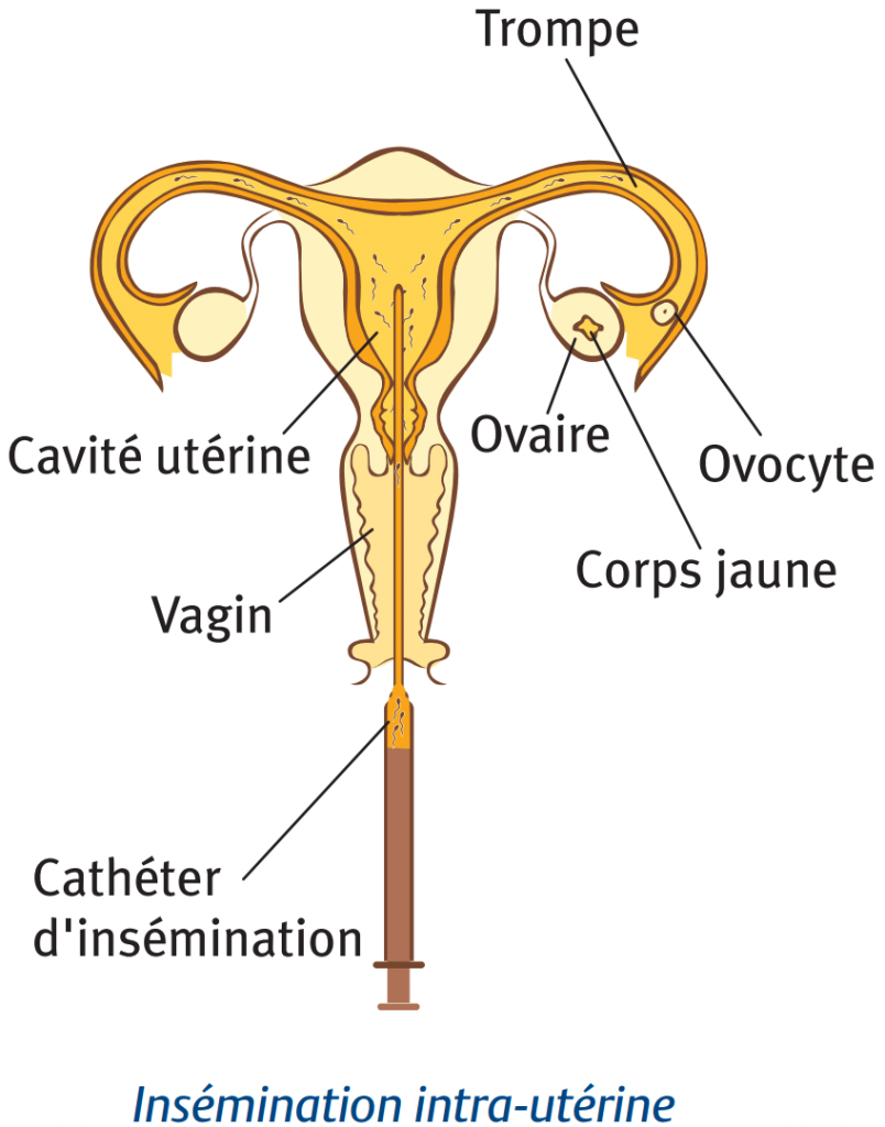 nombre spermatozoides insemination