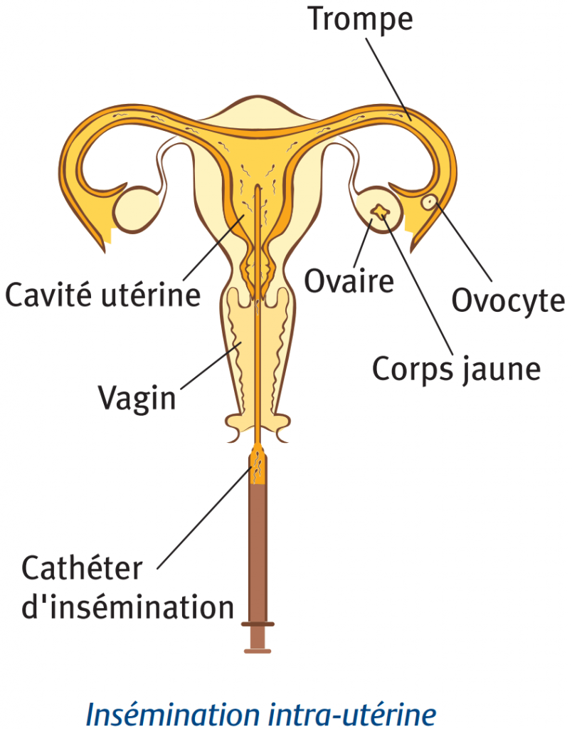 L'insémination utérine (dernière étape)